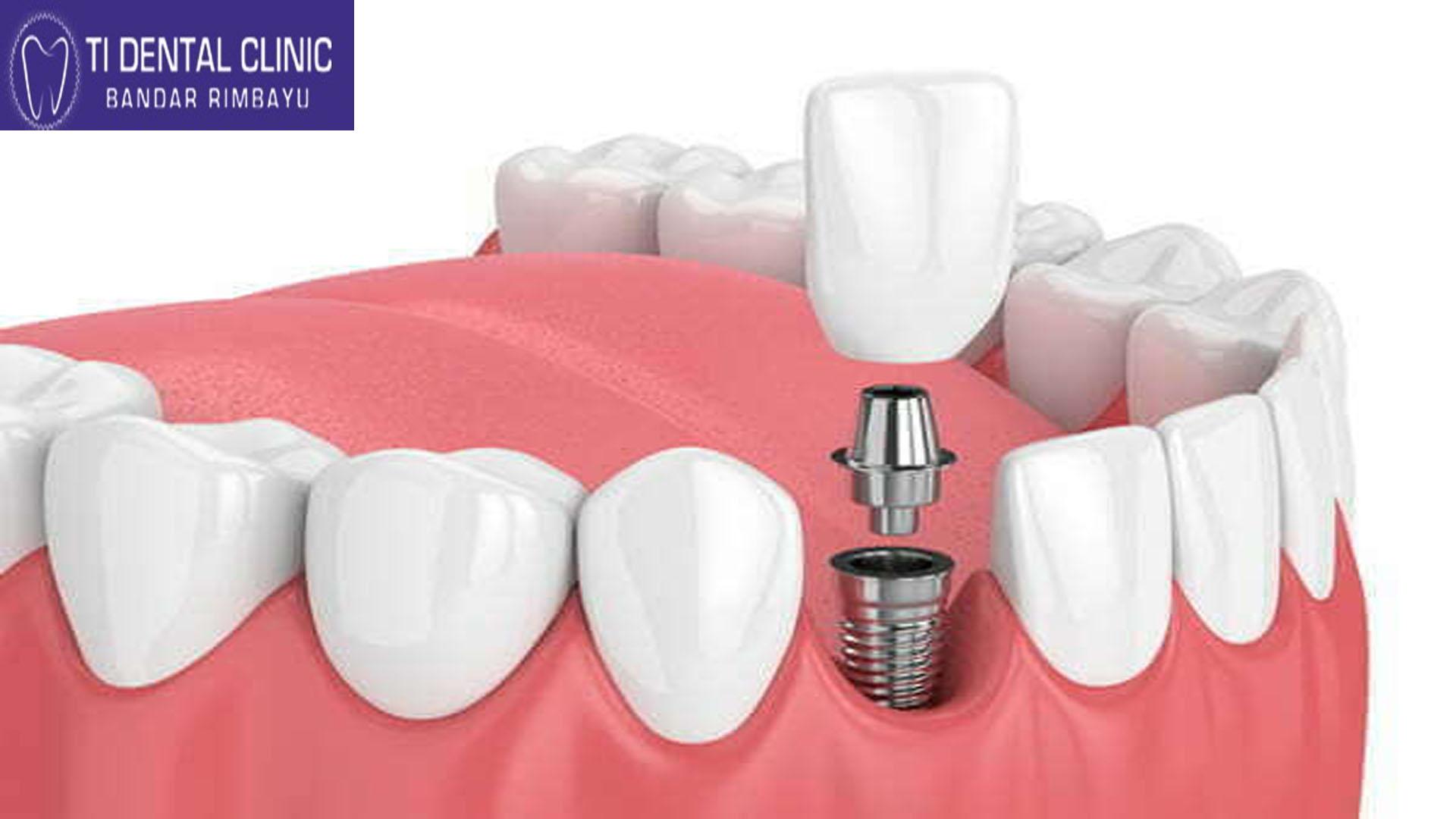 The Complete Guide to Dental Implants: Costs, Procedures, and What to Expect