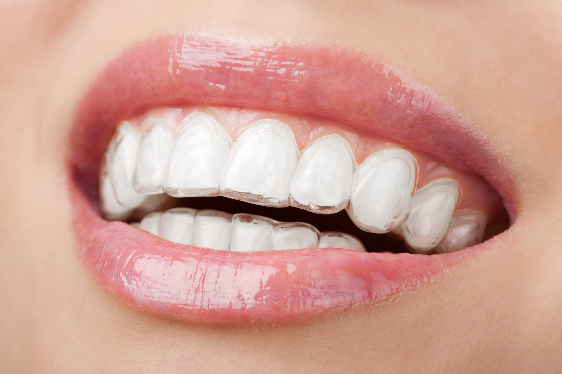 The Complete Guide to Dental Implants Cost: Value vs. Investment